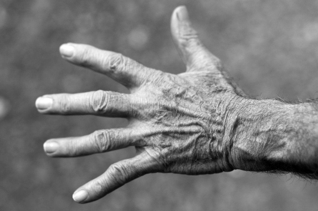 Egzema na dłoniach może wskazywać na obciążenie organizmu toksynami.
